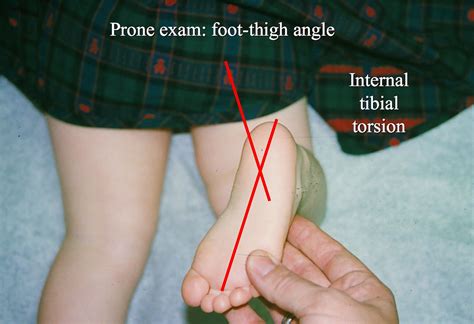 prone tibial torsion test|how to assess tibial torsion.